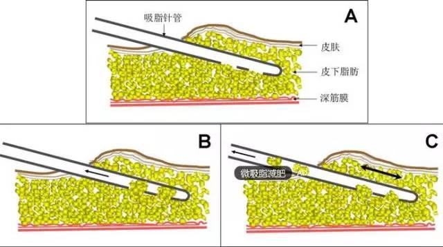 半永久化妝是微整形嗎？兩者有什么區(qū)別？